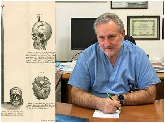Un italiano sobrevive dos días en su casa con una flecha clavada en la cabeza