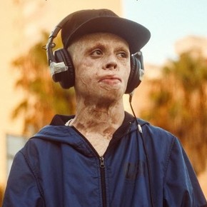 “El niño de fuego” que sobrevivió a un accidente que quemó todo su cuerpo: “Si tienes ganas de vivir, hay que luchar“